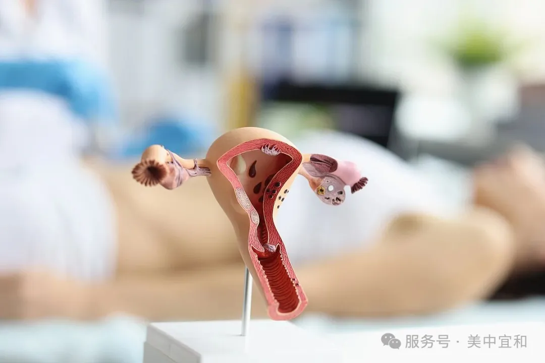 Uterine fibroid anatomy and surgical illustration